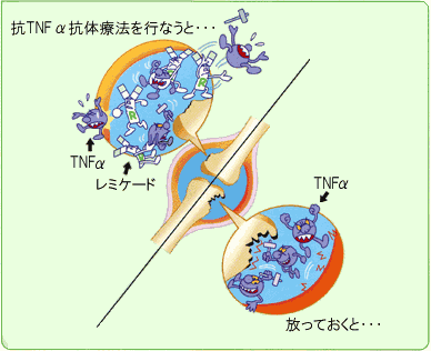抗TNFα抗体療法